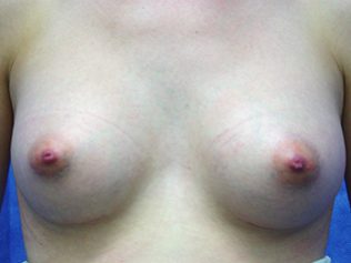 Breast augmentation after